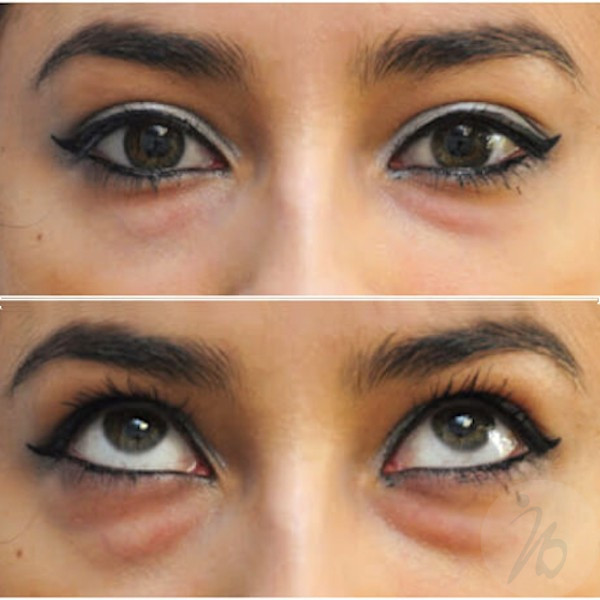 Blefaroplastia transconjuntival